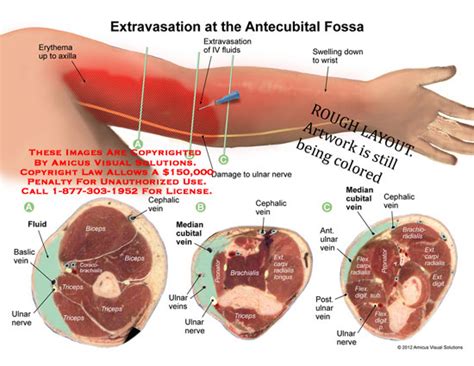 Amicus Illustration Of Amicusmedicalarmextravasationantecubital