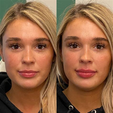 Top 97 Pictures Before And After Pictures Of Botox Around The Mouth