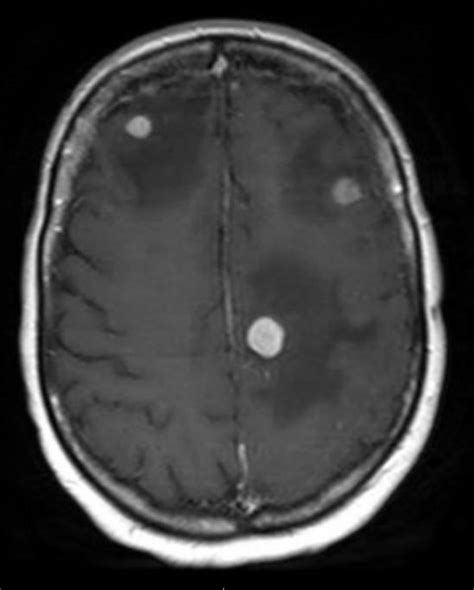 Brain Metastases Multidisciplinary Care Improves Outcomes Healthcare