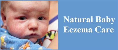 Natural Baby Eczema Care