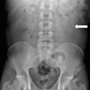 Figures Figure 1 Plain abdominal radiography | Download Scientific Diagram