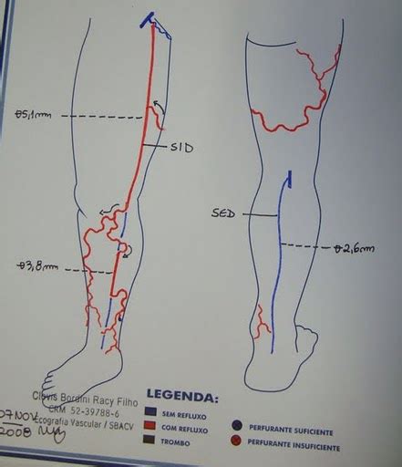 Espuma Eco Escleroterapia Dra Angela Maria Eugenio Angiologia E