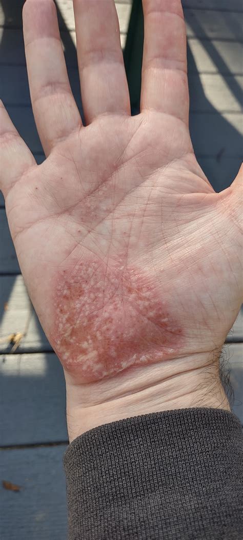 Guttate psoriasis relief? : Psoriasis