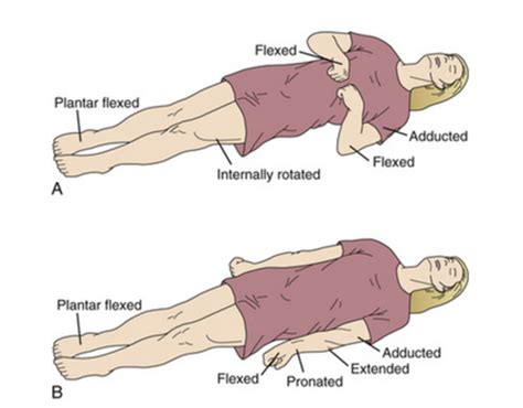 Acute Neuro conditions Flashcards | Quizlet 