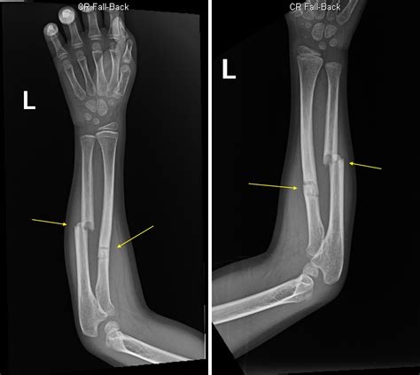 Ulna Fracture X Ray