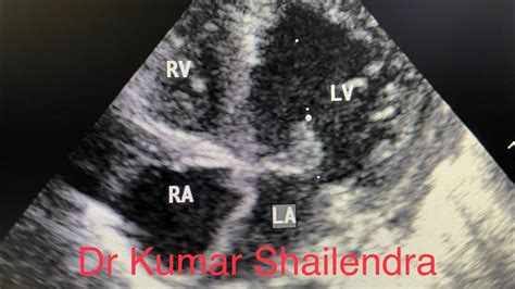 Tricuspid Valve Atresia YouTube