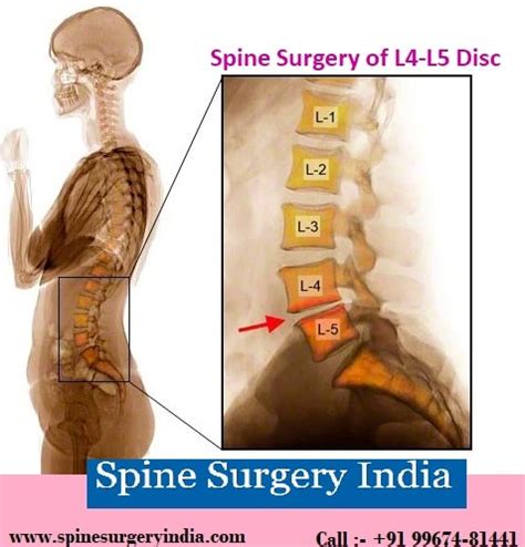 What is the Cost of Spine Surgery of L4-L5 Disc in India?