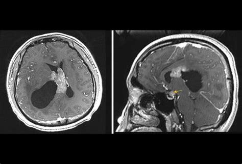 Brain Lesions Summaries Of 12 Cases