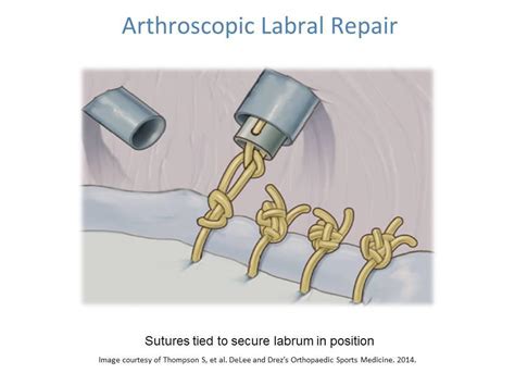 Shoulder Labral Tear Labral Repair And Rehabilitation Ashvin K Dewan Md