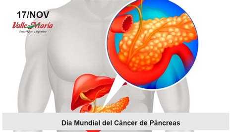 Día Mundial Del Cáncer De Páncreas Municipalidad De Valle María