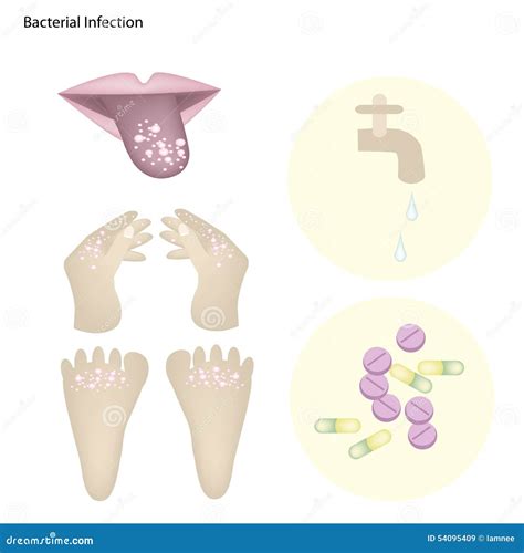 Bacterial Infection with Disease Prevention and Treatment Stock Vector - Illustration of ...