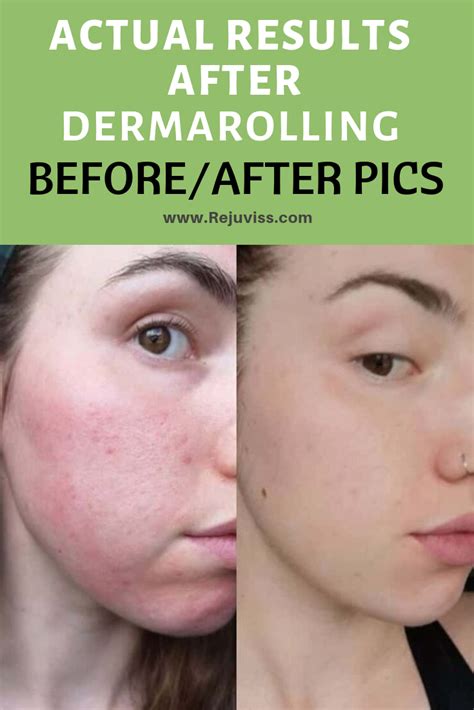 Dermarolling Before And After Face