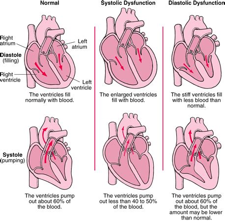 DIASTOLIC DYSFUNCTION - WeCare Germany