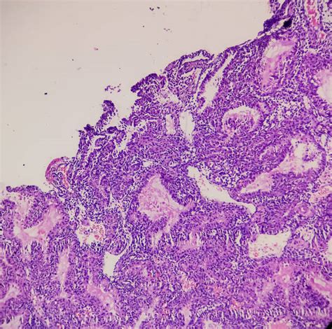 20+ Molar Pregnancy Stock Photos, Pictures & Royalty-Free Images - iStock