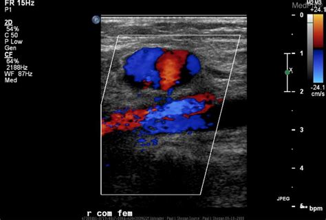 Femoral Artery Ultrasound