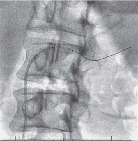 The angiojet thrombectomy was done inside the stent. | Download ...