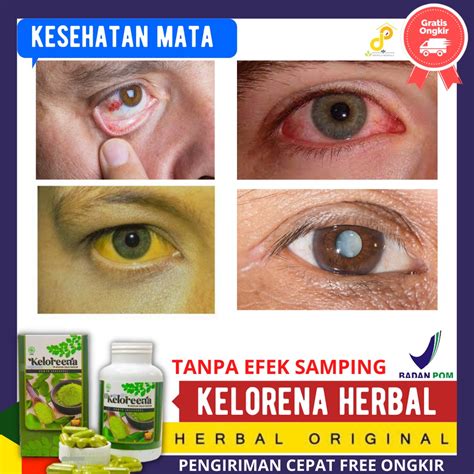 Jual Mengatasi Selaput Putih Pada Kornea Mata Bercak Putih Pada Mata