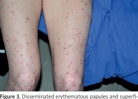 Figure 3 From Pruritic Cutaneous Lesions Mimicking Dermatitis Artefacta