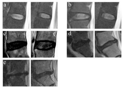 Jpm Free Full Text Analysis Of Degenerative And Isthmic Lumbar