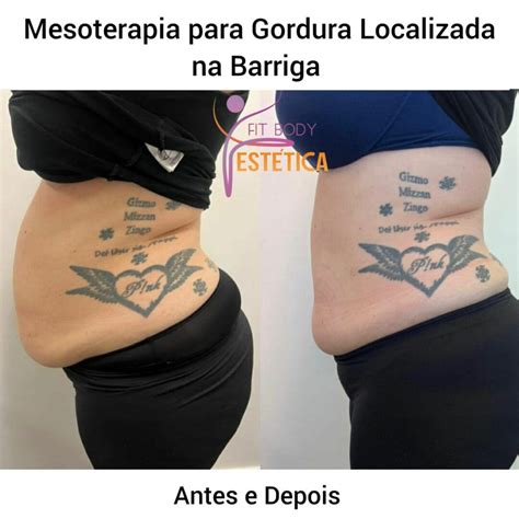 Mesoterapia Para Gordura Localizada Na Barriga Drasacha