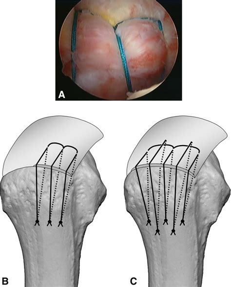 A An Intraoperative View And B A Diagram Shows The Rotator Cuff Download Scientific Diagram