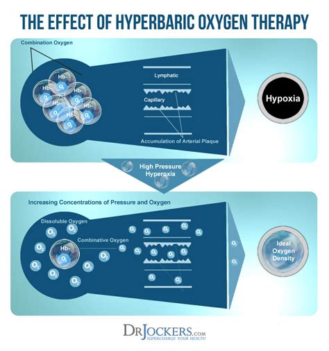 The Health Benefits of HyperBaric Oxygen - DrJockers.com