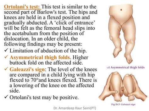 Congenital Hip Dislocation PPT