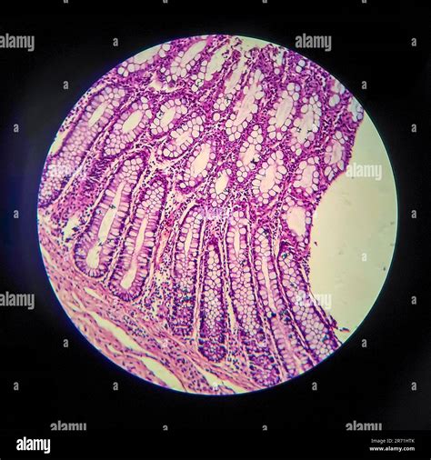 Bacillary dysentery, light micrograph, photo under microscope showing ...