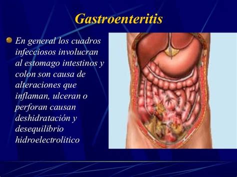 Gastroenteritis