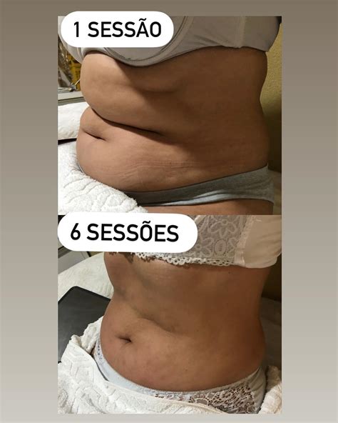 Remodelamento corporal sem criolipólise e sem cirurgia Andressa