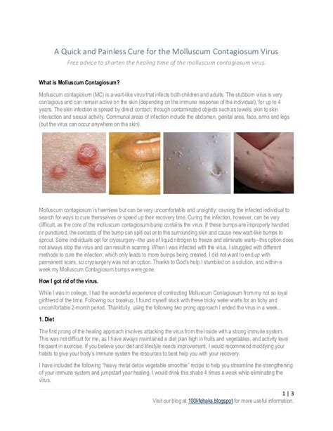 Molluscum Contagiosum Apple Cider Vinegar Treatment Quotes Trendy New