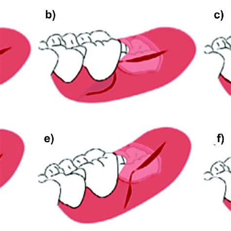 Pdf Management Of Mandibular Third Molar Surgery To Preserve