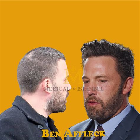 Ben Affleck Hair Transplant Amazing Transformation 2024