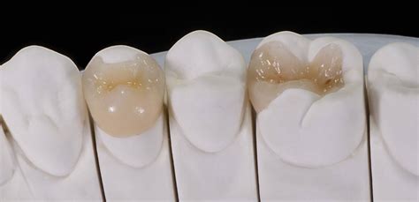 All Ceramic Dental Restorations Denver Cosmetic Dentist Dental Crowns