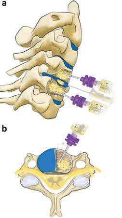 Plasma Rich In Growth Factors Prgf In The Treatment Of Cervical And