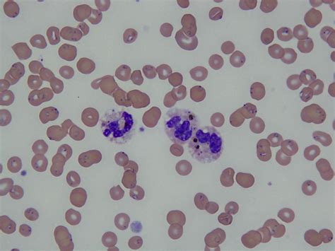 Pathology Outlines Plasmodium Falciparum