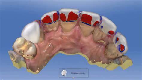 Digital Anterior Bite Plane - Spear Education