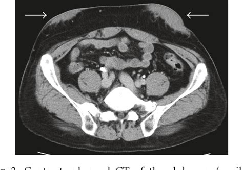 Figure 2 from Localized Subcutaneous Insulin-Derived Amyloidosis