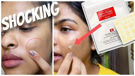 WHAT Acne Gone In 24 Hours Acne Pimple Patch Test KOREAN Skin Care