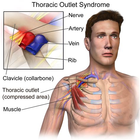 Neurogenic Thoracic Outlet Syndrome Testing Precision Medical Group