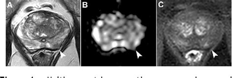 Figure From The Current Role Of Prostate Multiparametric Magnetic