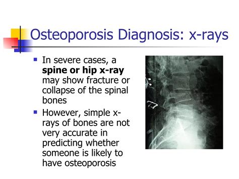 Osteoporosis prevention and management | PPT | Free Download