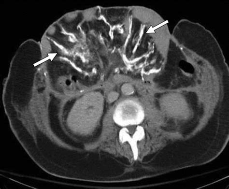 Diagnostic Approach To Benign And Malignant Calcifications In The Abdomen And Pelvis Radiographics