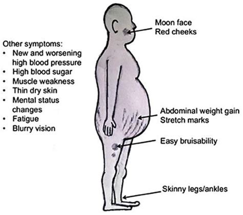 Figure 1 From A Case Of Paraneoplastic Cushing Syndrome Presenting As