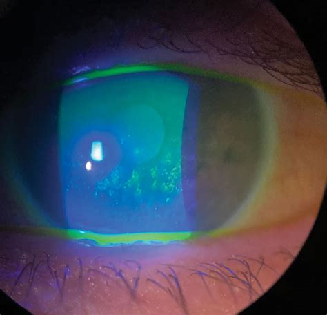 Keratoconjunctivitis Sicca Humans