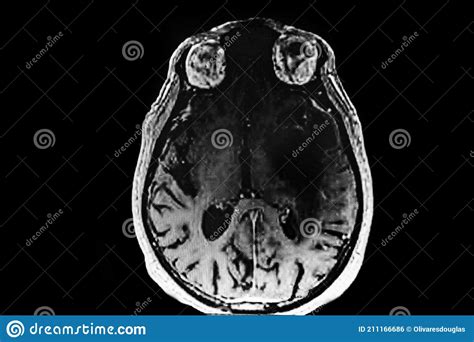 CAT - Scan of brain tumor stock photo. Image of lobe - 211166686