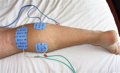 Estimulaci N El Ctrica Neuromuscular Una Opci N Terap Utica En