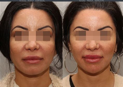 Masseter Botox Botox For Jawline Lumier Medical