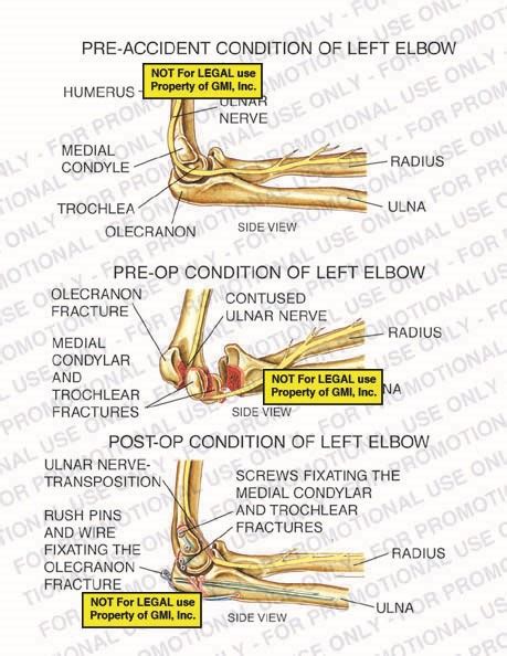 Pre Accident Vs Pre Op Vs Post Op Conditions Of Left Elbow 95087aba Generic Medical Legal