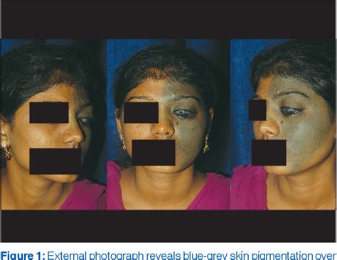 Figure 1 From Giant Nevus Of Ota Semantic Scholar